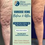 Today is #TransformationTuesday!, Vein Specialists of the Carolinas Understanding Varicose Veins and Our Specialized Care in Gastonia and Charlotte, NC