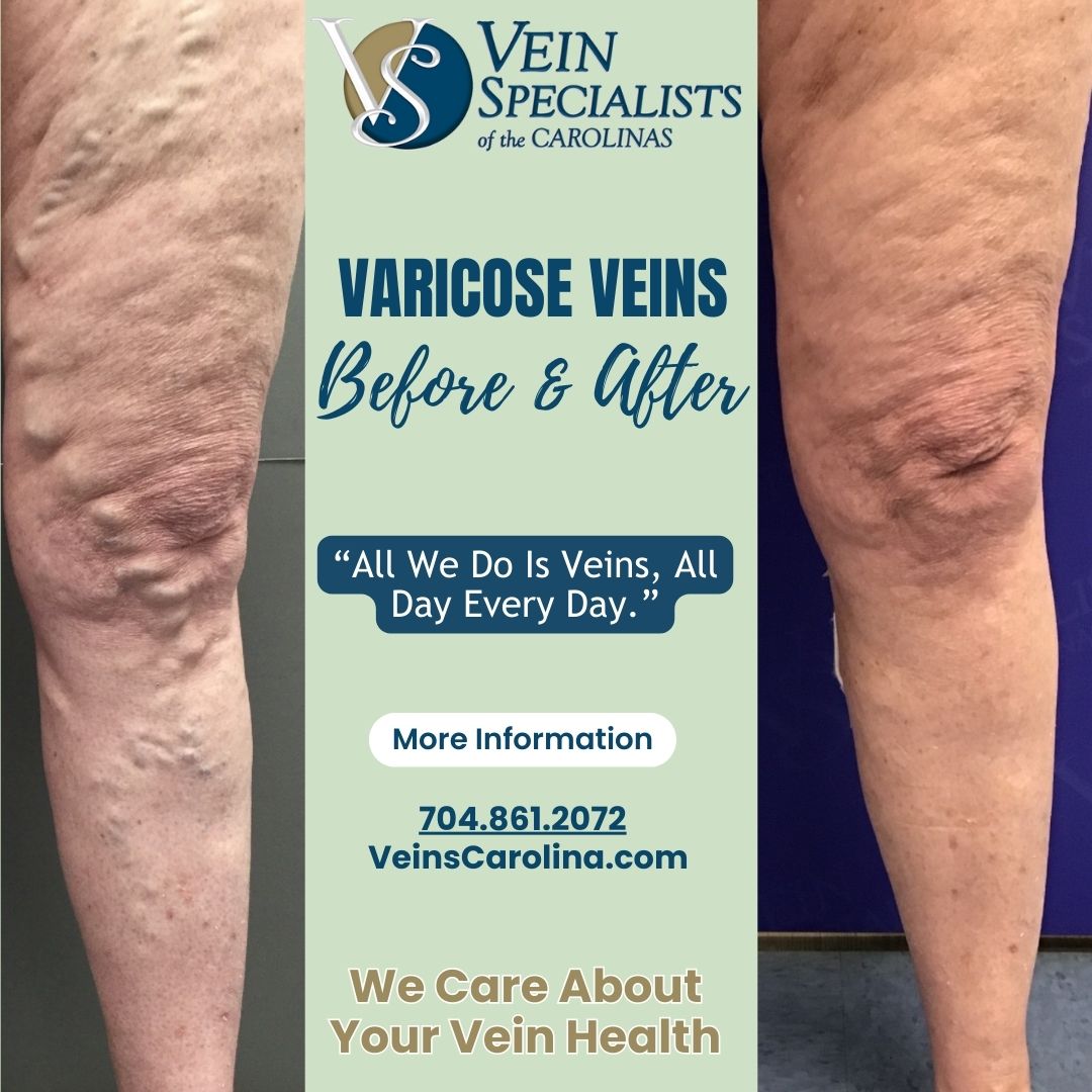 Understanding Varicose Veins and Our Specialized Care in Gastonia and Charlotte, NC