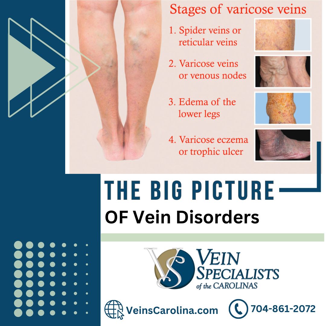 The Big Picture of Vein Disorders: Understanding Chronic Venous Hypertension