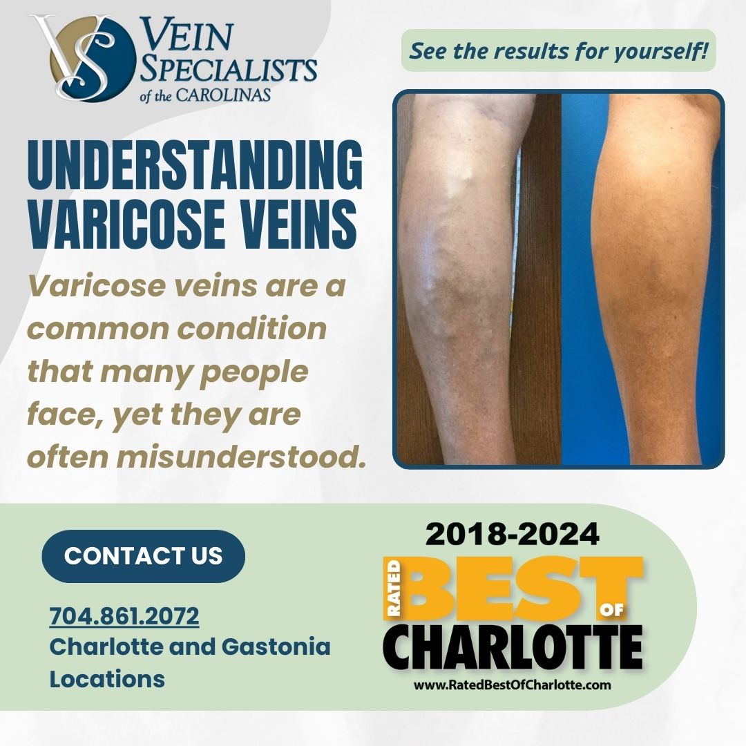 Understanding Varicose Veins: FAQs from Vein Specialists of the Carolinas